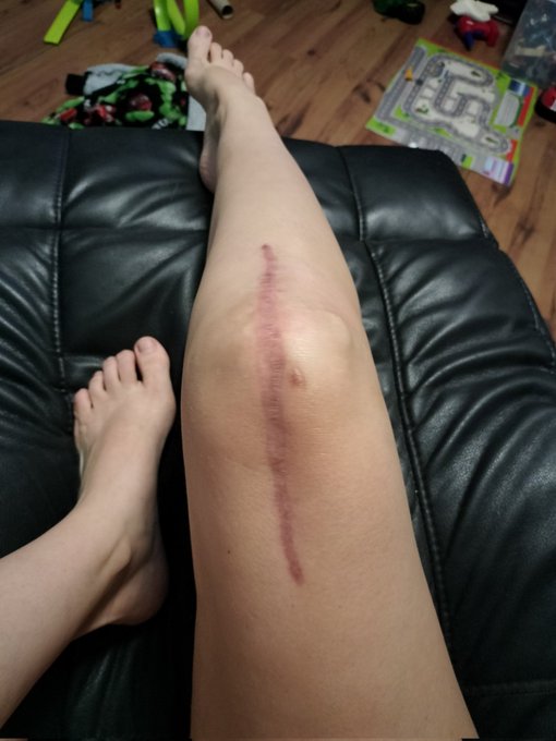 Does my scar turn you on 🥵😂 https://t.co/G1Di5gWrPU