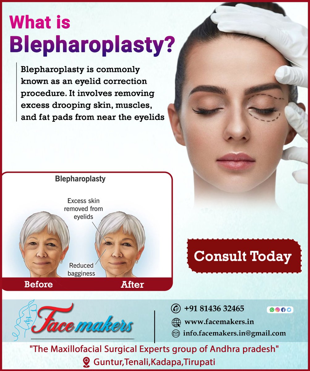 What is Blepharoplasty ?
For appointment :+ 91 81436 32465
#blepharoplasty #rhinoplasty #facemakersteam #eyelidcorrection
#abnormalitiesburns #skincare #eyelidsurgery
#tonguecancer #cancercare #chronictonguecancer&jaw
#cleftlip &palate #roofofmouth #bothlip