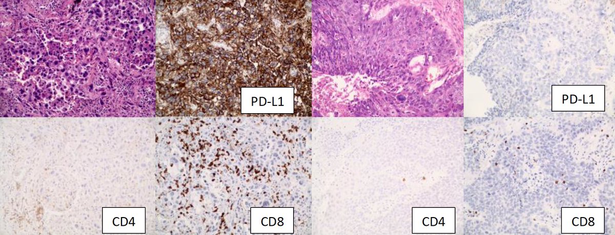 Clinical Lung Cancer (@clinicallung) on Twitter photo Lung cancer significantly contributes to morbidity and mortality among people with HIV.
A recently published article in <a href="/ClinicalLung/">Clinical Lung Cancer</a> analyzes clinicopathological characteristics, including immunotherapy outcomes, for 174 #PWH diagnosed with lung cancer.
bit.ly/46T6zKk Lung cancer significantly contributes to morbidity and mortality among people with HIV.
A recently published article in <a href="/ClinicalLung/">Clinical Lung Cancer</a> analyzes clinicopathological characteristics, including immunotherapy outcomes, for 174 #PWH diagnosed with lung cancer.
bit.ly/46T6zKk