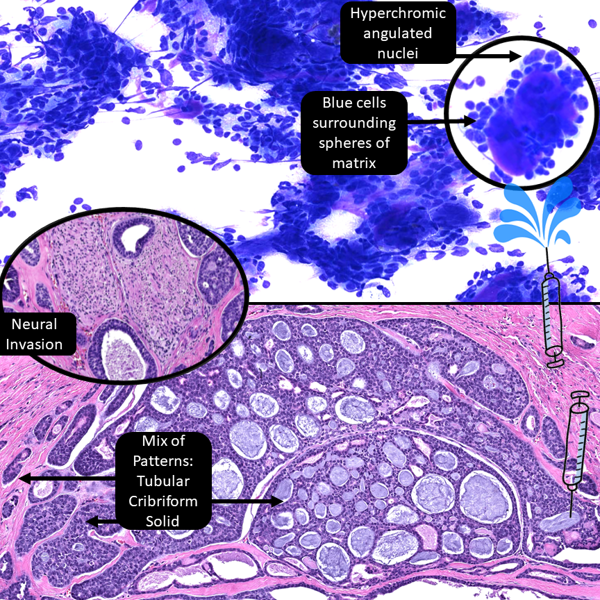 DrCycloPath's tweet image. Salivary gland, ___ carcinoma.
A) adenoid cystic
B) acinic cell
C) salivary duct
D) mucoepidermoid
#CytoPath #DermPath #PathResidents #PathTwitter #ENTPath #BSTPath
🔬pathpresenter.net/public/display… # 8 &amp;amp; 9