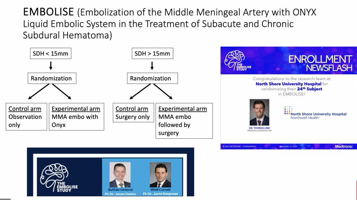 To find out more about EMBOLISE, a clinical trial here for middle meningeal artery embolization for the treatment of subacute and chronic subdural hematoma, please check out: northwell.edu/clinical-trial…