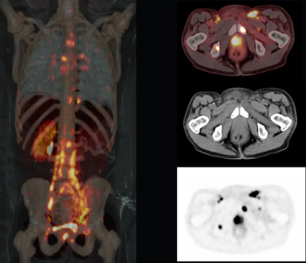 LEARN WITH PHENOMICS!

Comments on Study of “Performance of 18F-DCFPyL PET/CT in Primary Prostate Cancer Diagnosis, Gleason Grading and D'Amico Classification: A Radiomics-Based Study”
#molecularimaging 
link.springer.com/article/10.100…
Fig: siemens-healthineers.com/en-uk/molecula…