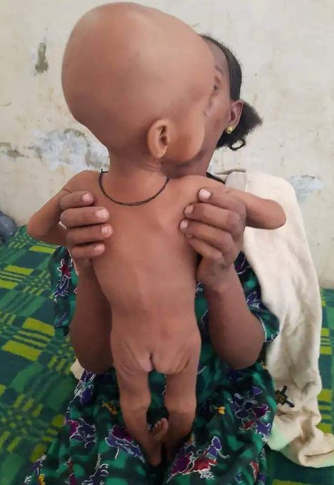 Medicines.After the genocidalwar, children in this area did not receive medical services.They were not vaccinated or treated.

As a result, they are dying and suffering from variousdiseases.
#AllowHumanitarianAccessToTigray 
@MikeHammerUSA @EUSR_Weber @UKinEthiopia @FAO