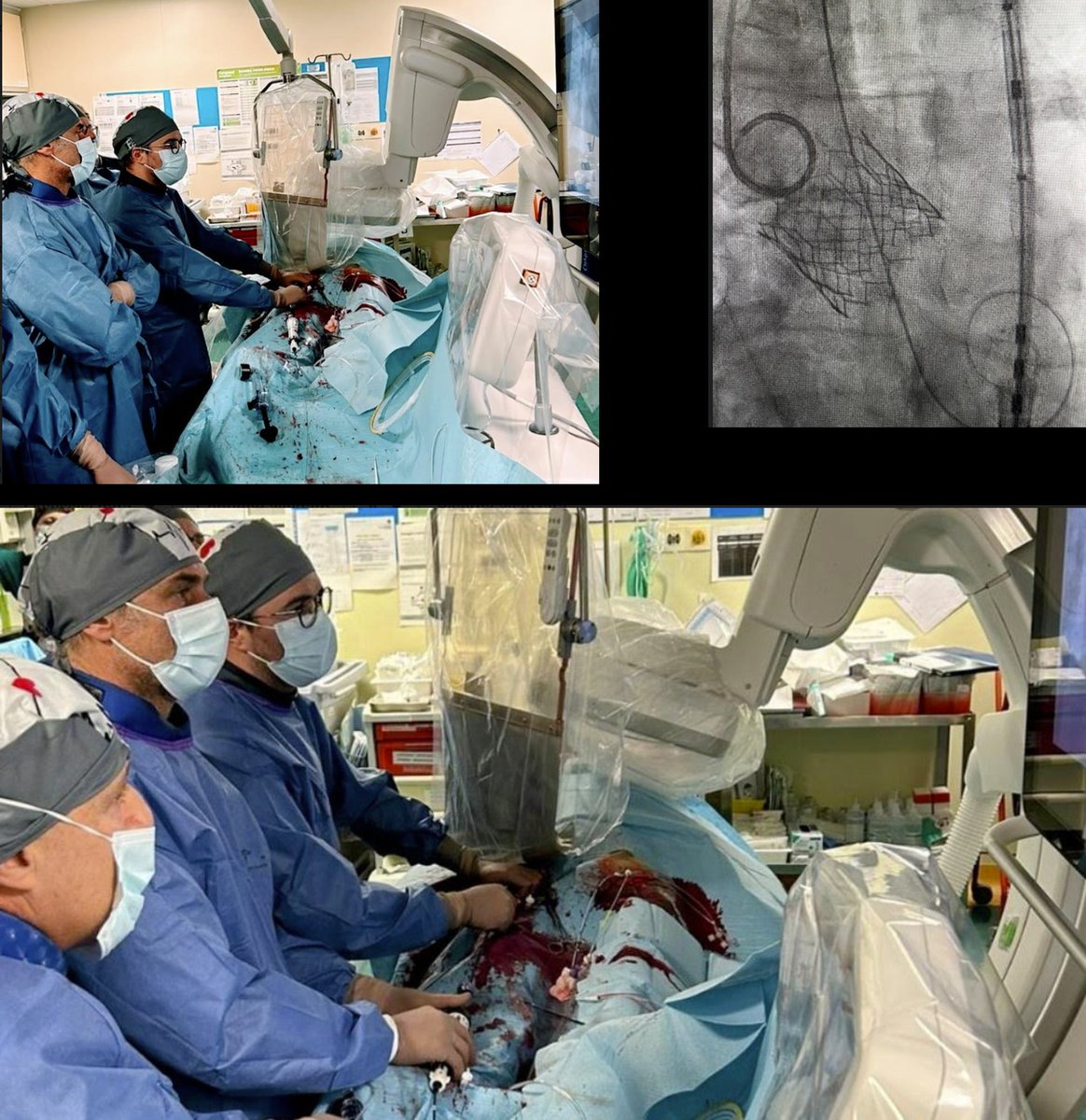 MatteoReccia (@recciamatteo) on Twitter photo First in First TAVI: an honor and pleasure for me to be the First operator during first Tuscan TAVI in a centre without cardiac surgery unit onsite. Thanks to my mentors and masters @bologneseleonardo <a href="/MASSIMO90417726/">MASSIMO FINESCHI</a> <a href="/FrancescoLiist2/">Francesco Liistro</a> <a href="/aiadanza71/">Alessandro Iadanza</a>.. welcome to TRACS First in First TAVI: an honor and pleasure for me to be the First operator during first Tuscan TAVI in a centre without cardiac surgery unit onsite. Thanks to my mentors and masters @bologneseleonardo <a href="/MASSIMO90417726/">MASSIMO FINESCHI</a> <a href="/FrancescoLiist2/">Francesco Liistro</a> <a href="/aiadanza71/">Alessandro Iadanza</a>.. welcome to TRACS