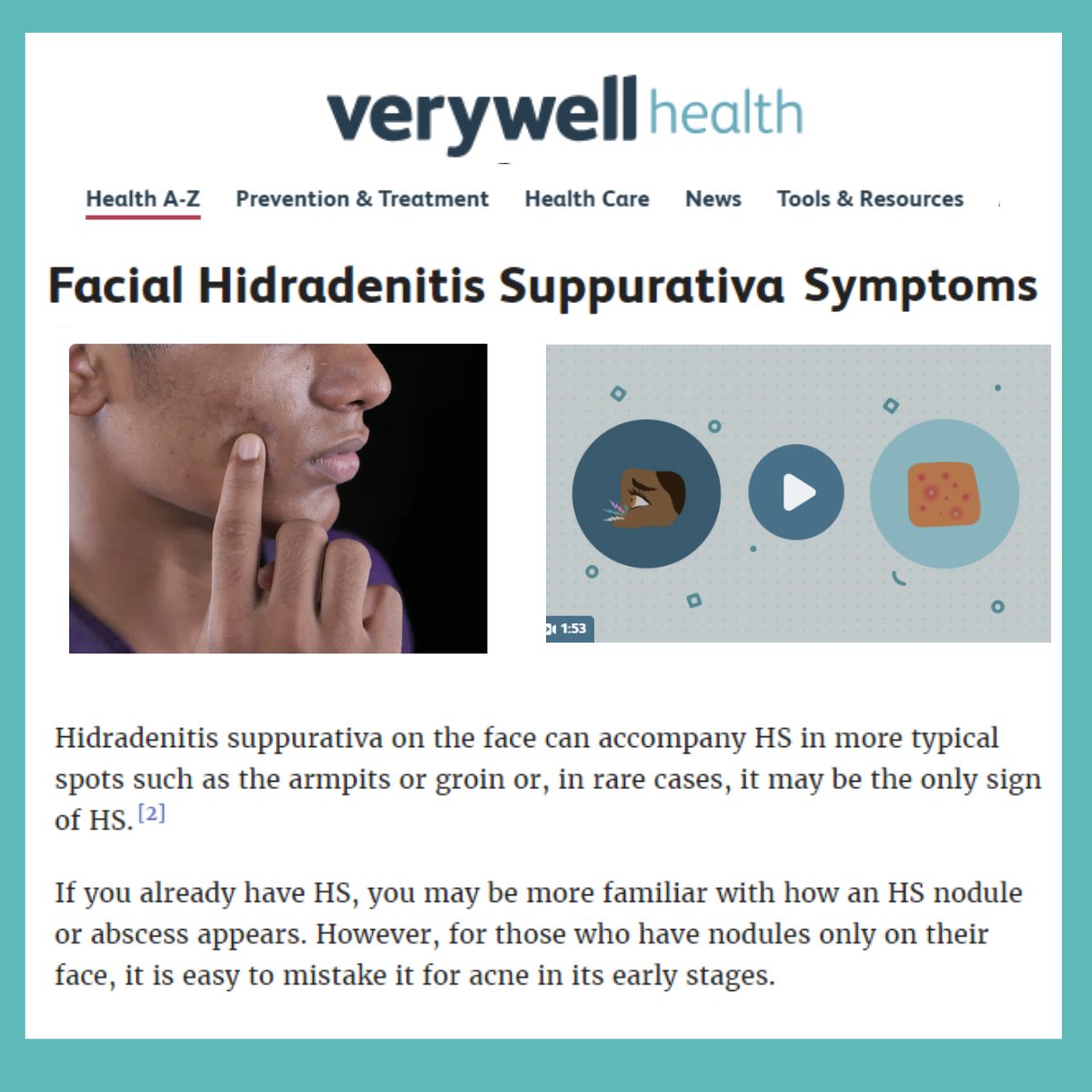 Facial Hidradenitis Suppurativa - in this article, <a href="/Verywell/">Verywell Health</a> looks at the
✅ Symptoms
✅ Causes
✅ Treatment
✅ Lifestyle Changes
✅ Coping

Take a look 👇
verywellhealth.com/hidradenitis-s…

#hidradenitissuppurativa #HSWarrior #BeAGP #MedTwitter #DermTwitter