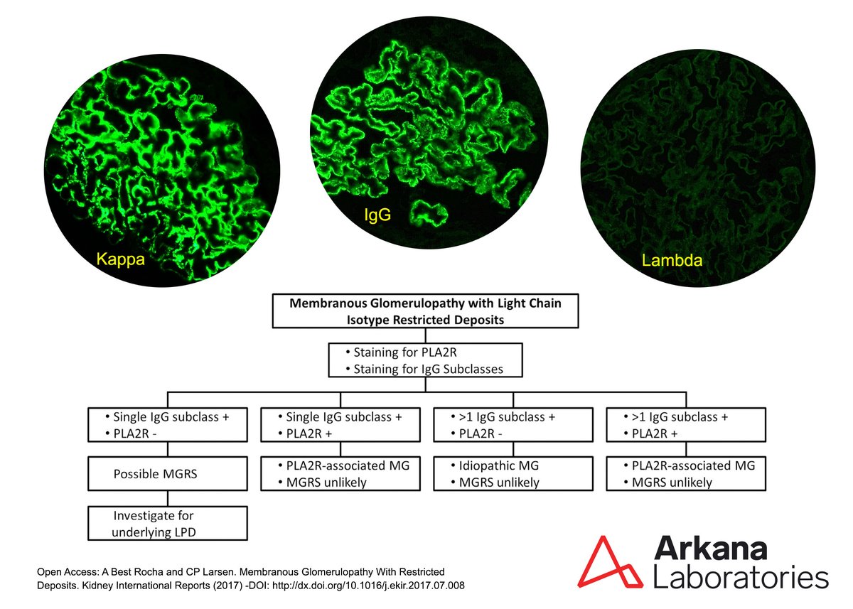 arkanalabs's tweet photo. #TeachingPoint Membranous glomerulopathy (MG) is a common cause of nephrotic syndrome that results from the formation of immune complexes along the subepithelial aspect of the glomerular basement membranes. Approximately 1% of membranous cases will show light chain restriction by immunofluorescence. The majority of MG cases with light chain restricted deposits lack a recognizable secondary etiology. However, absence of PLA2R-positivity within glomerular deposits, positive staining for a single IgG subclass and presence of focal proliferation by light microscopy are worrisome histopathologic features that should prompt a thorough clinical workup to exclude the presence of an underlying lymphoproliferative disorder, even in the absence of a recognizable paraprotein.