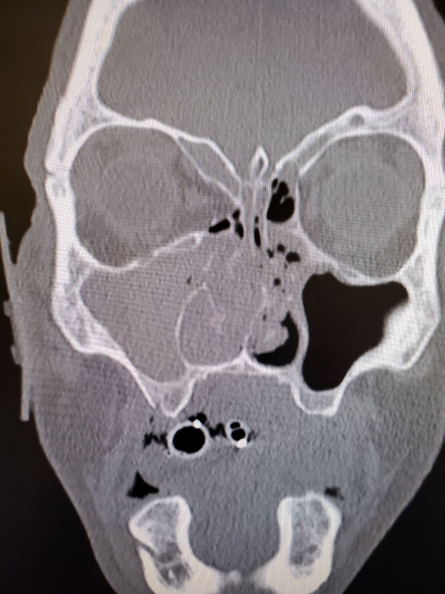 A patient with an orbital fracture and signs of entrapment needs urgent follow-up within 24hrs and corticosteroids to minimize swelling and expediate improvement in diplopia #TraumaTuesday