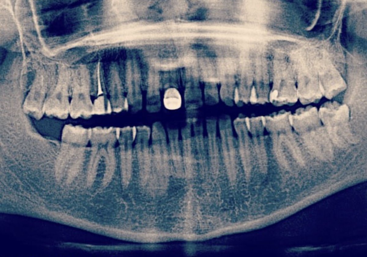 EbruOzcn's tweet image. 11’deki kaplama, 15’teki kanal, yoklamada 48 numarayı yok yazdığımız serseri  20’lik… ben her halimle güzelim 😎 #dişchallenge