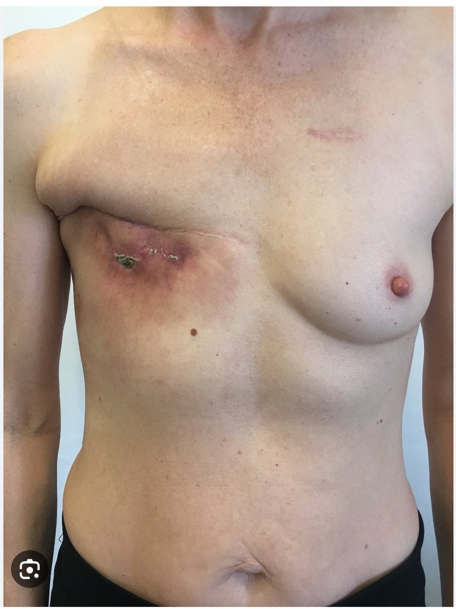 MaryMacElveen's tweet photo. @NikkiHaley So, Governor @ChrisSununu just endorsed @NikkiHaley who believes that parents have the right to do this to their child. This is a far tamer photo that I have seen of child #SexualMutilation. BTW, the top surgery you see here was botched. https://t.co/81nzwrqMqy