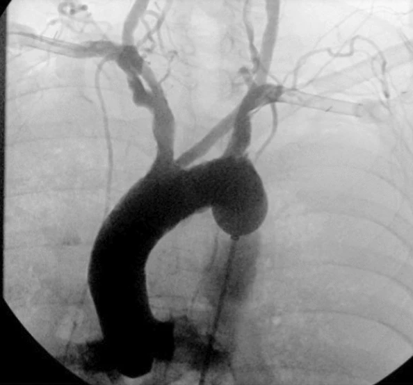 Selective aortic arch perfusion - our first-in-human SAAP paper - an endovascular resusc modality - Open Access: tinyurl.com/28mxt3cu @MaxMarsden83 @EMDocJB @JManning_UNC @BartsHospital @BartsIntervGrp @EastAngliAirAmb @StAndMedicine @CdreAHofman @miltropmeddoc #OHCA #ECMO