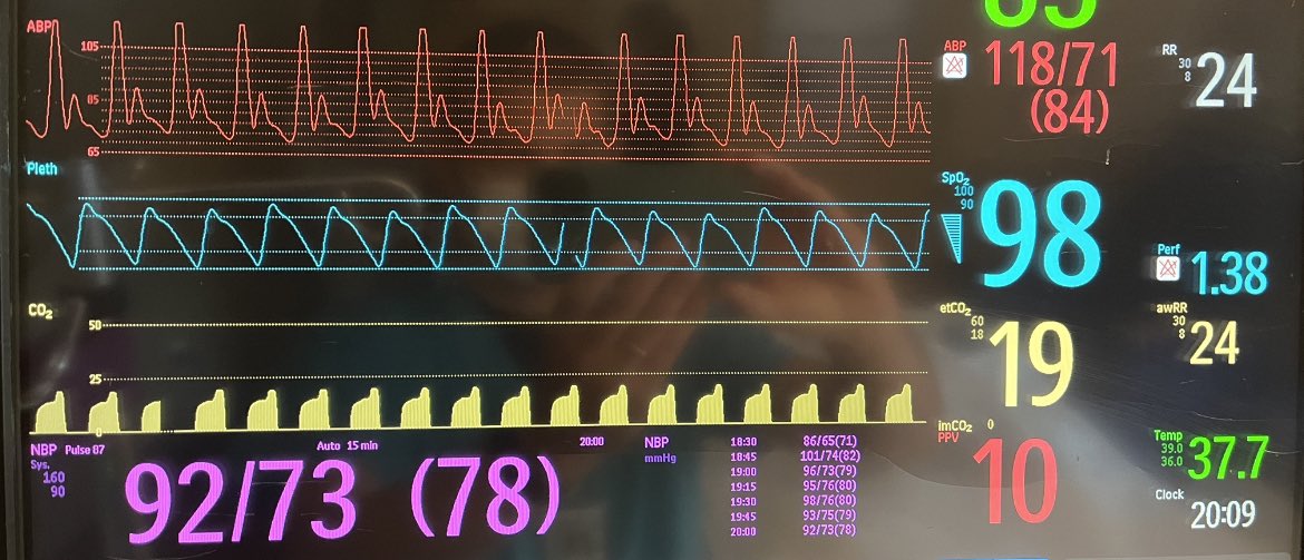 This is one of the most important ETCO2 patterns to recognize.

What is the significance of this ETCO2 waveform in a person admitted with STEMI who has been failing SBTs due to tachypnea?

(Quiz & 🧵 below)
