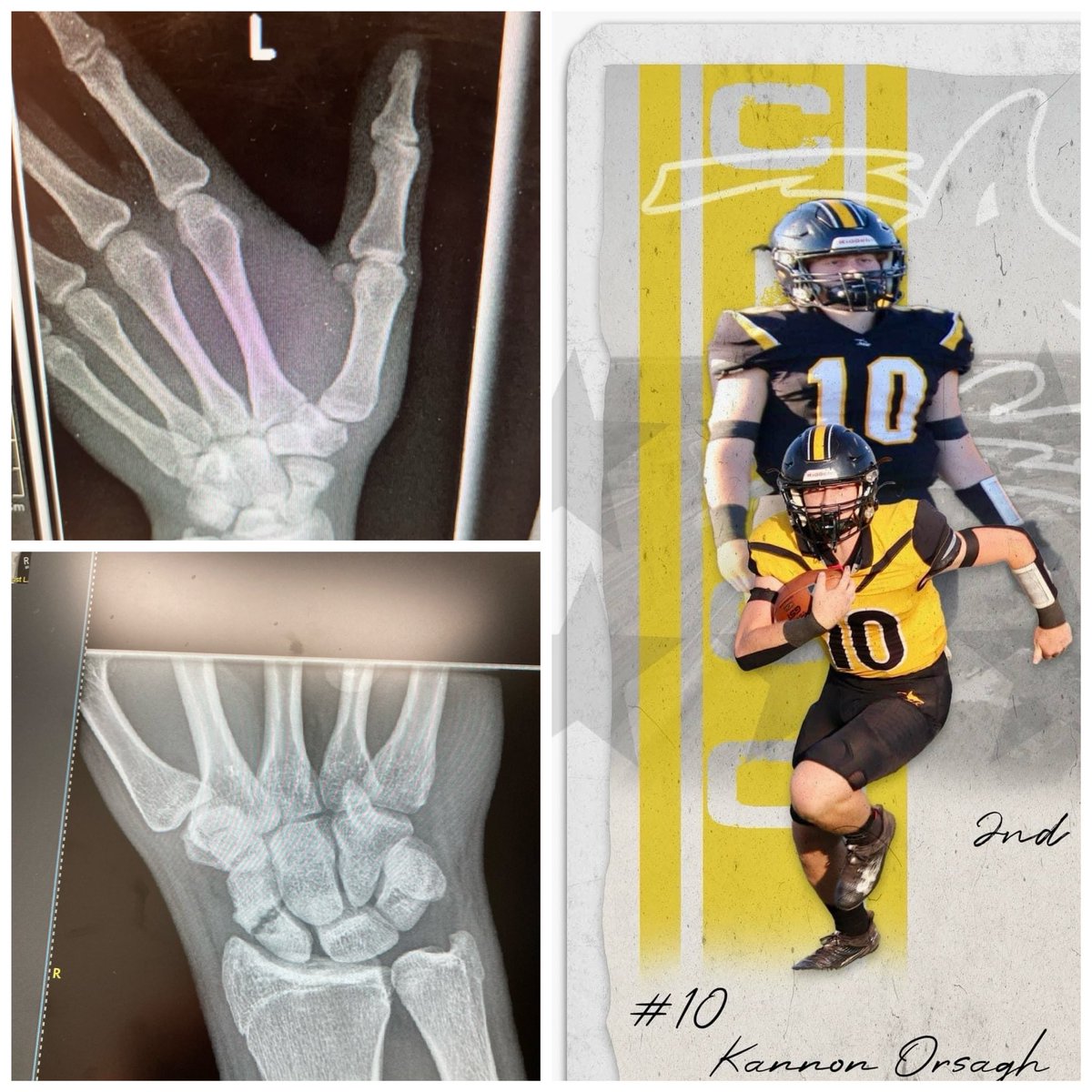 Had to go in to the hand specialist with Kannon to look at the left hand and a follow up on the right. He ended up breaking the left back in October. Talk about one tough kid! Played the season with not one, but two broke hands. Not many QBs out there could make it through that!