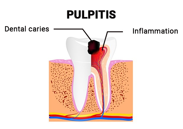 DentalReports's tweet image. Pulpitis is an inflammation of the pulp, the soft inner tissue of the teeth. The dentist will treat the cause and expect the symptoms to resolve. The main sign that the pulpitis has progressed to irreversible pulpitis is a lingering sensitivity to heat or cold.
#Pulpitis