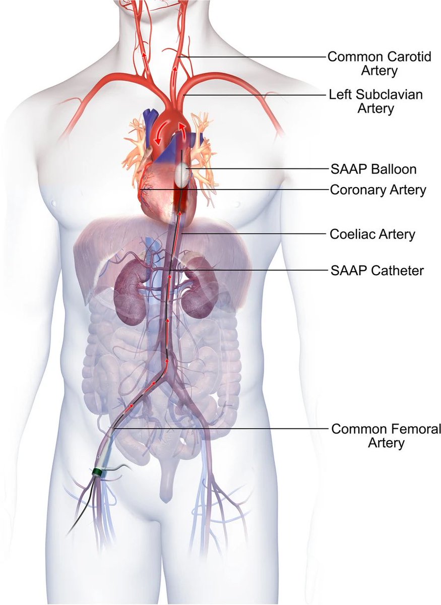 Very pleased to see our work on #SAAP published @SJTREM tinyurl.com/28mxt3cu Looking forward to more discussion and dialogue to understand how to make it deliverable #trauma #OHCA @EastAngliAirAmb @EAAARAID @DefProfEM @DMS_MilMed @ResearchUhnm @talherer @EVTMSociety