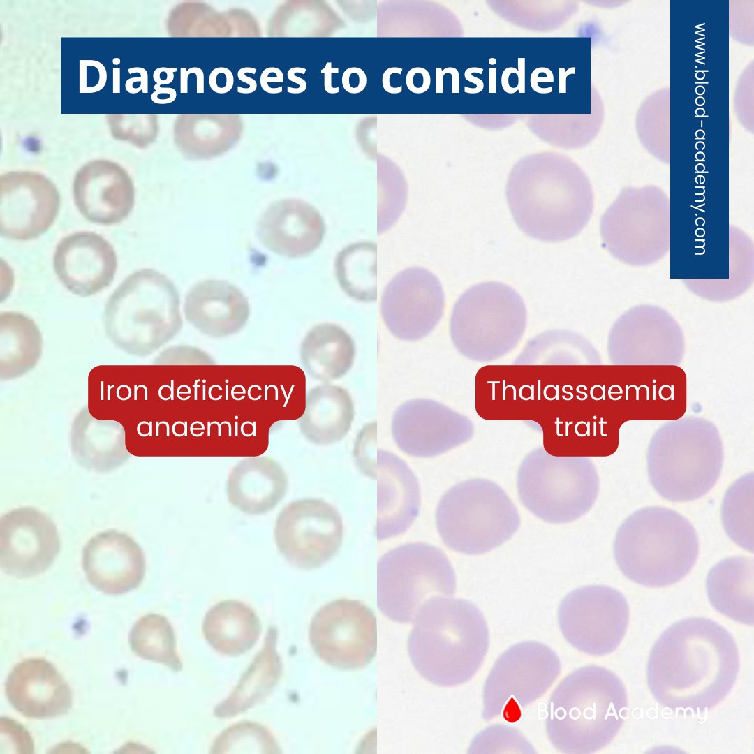1 What Is Hypochromia And More a Short Thread Thread From Blood 1-what-is-hypochromia-and-more-a-short-thread-thread-from-blood