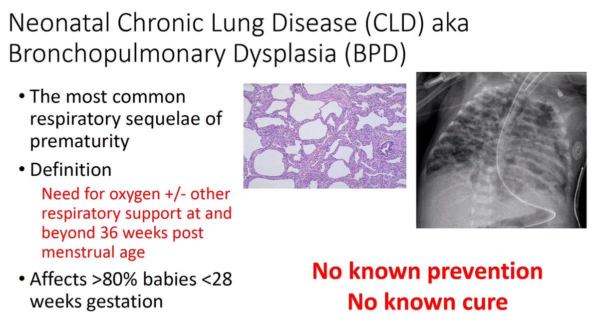 Evidence-Based Neo (@ebneo) on Twitter photo Next, Dr. Ju Lee Oei asks: can we safely monitor O2 in infants with BPD without all those wires!
First, Dr. Oei emphasizes the burden of BPD:
#HotTopicsNeo2023 <a href="/HotTopicsNeo/">Hot Topics in Neonatology</a> #neoebm #neoTwitter Next, Dr. Ju Lee Oei asks: can we safely monitor O2 in infants with BPD without all those wires!
First, Dr. Oei emphasizes the burden of BPD:
#HotTopicsNeo2023 <a href="/HotTopicsNeo/">Hot Topics in Neonatology</a> #neoebm #neoTwitter