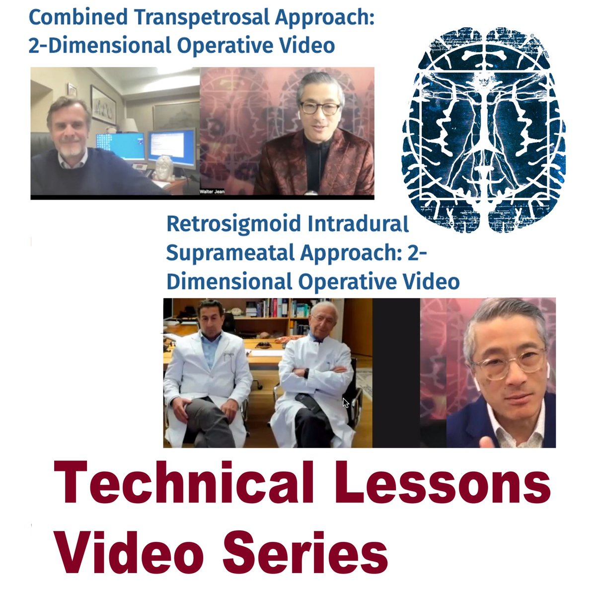 Two giant episode of #TLVS just went LIVE! Watch @SC_Froelich discuss his fave: petroclival meningiomas and the father-son team Amir and Madjid Samii #icon discuss #RISA journals.lww.com/onsonline/Page… @NeurosurgeryCNS