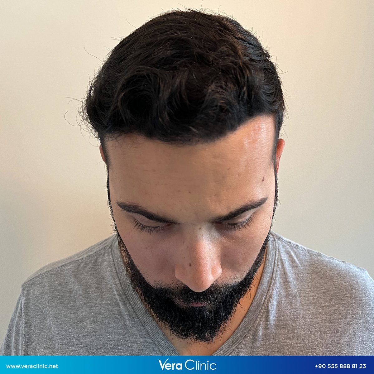 Witness the incredible journey of this hair transplant before and after results, nine months apart. 🤩 Get a free consultation: 📲 +90 555 888 81 23 👉 veraclinic.net #hairtransplant #hairtransplantturkey