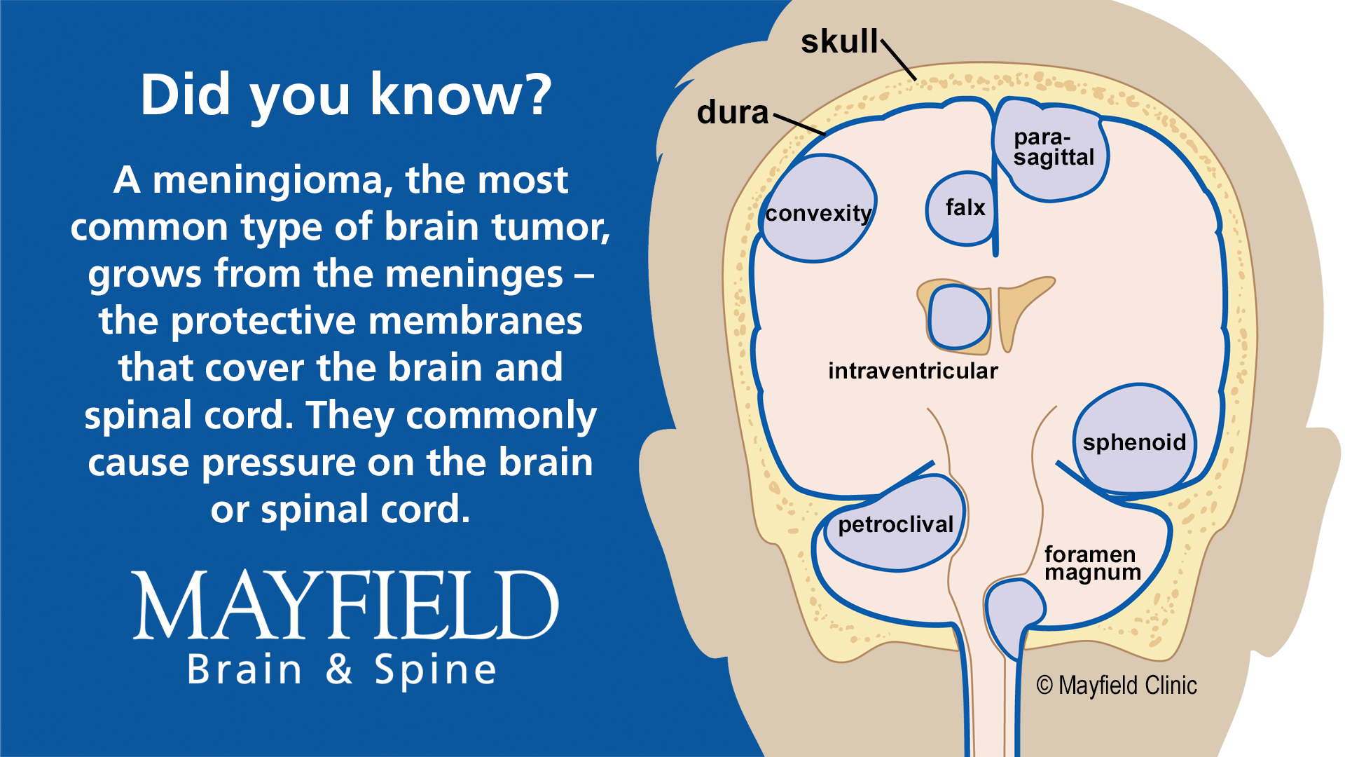 Mayfield Brain & Spinal Column