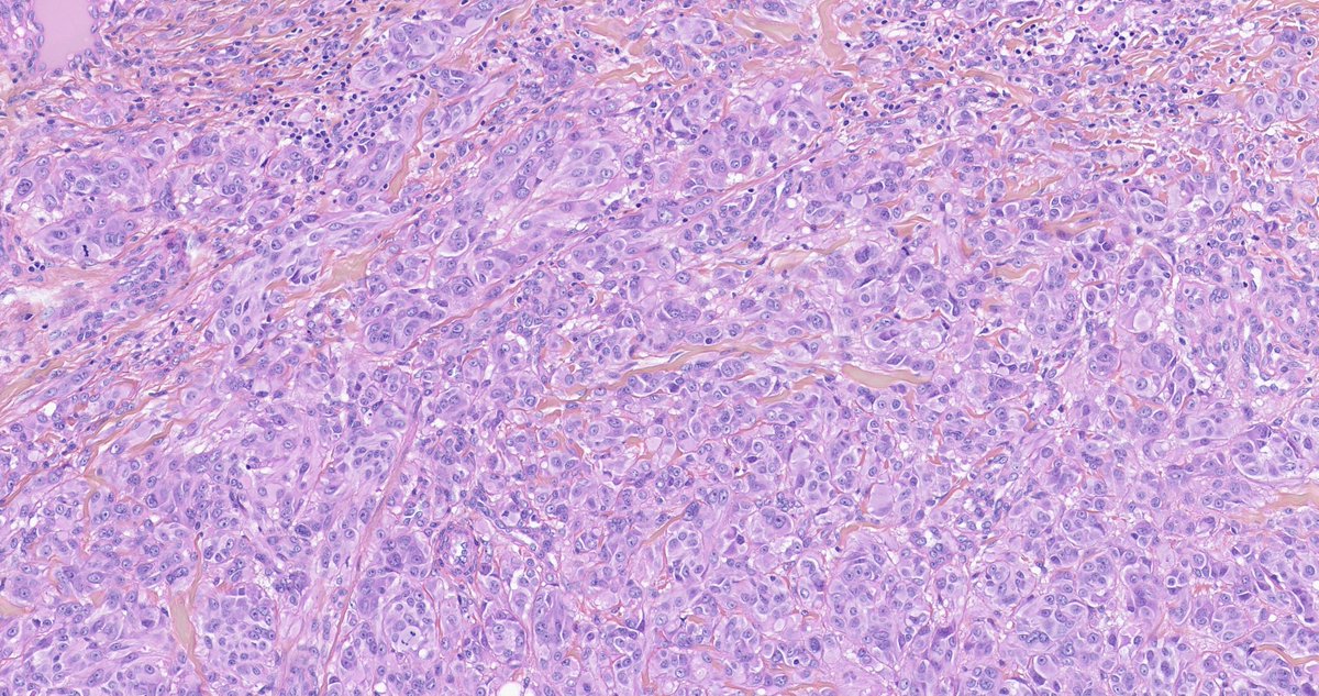 Dimitris Goutas MD, PhD (@goutasdimitris) on Twitter photo Spitz series 4/5 from the consult files of <a href="/melanopath/">Arnaud de la Fouchardiere MD, PhD</a>
Multinucleated melanocytes, with moderate atypia, arranged in a sheet-like growth pattern in this MAP3K8-fused Spitz tumor #dermpath #dermatology Spitz series 4/5 from the consult files of <a href="/melanopath/">Arnaud de la Fouchardiere MD, PhD</a>
Multinucleated melanocytes, with moderate atypia, arranged in a sheet-like growth pattern in this MAP3K8-fused Spitz tumor #dermpath #dermatology