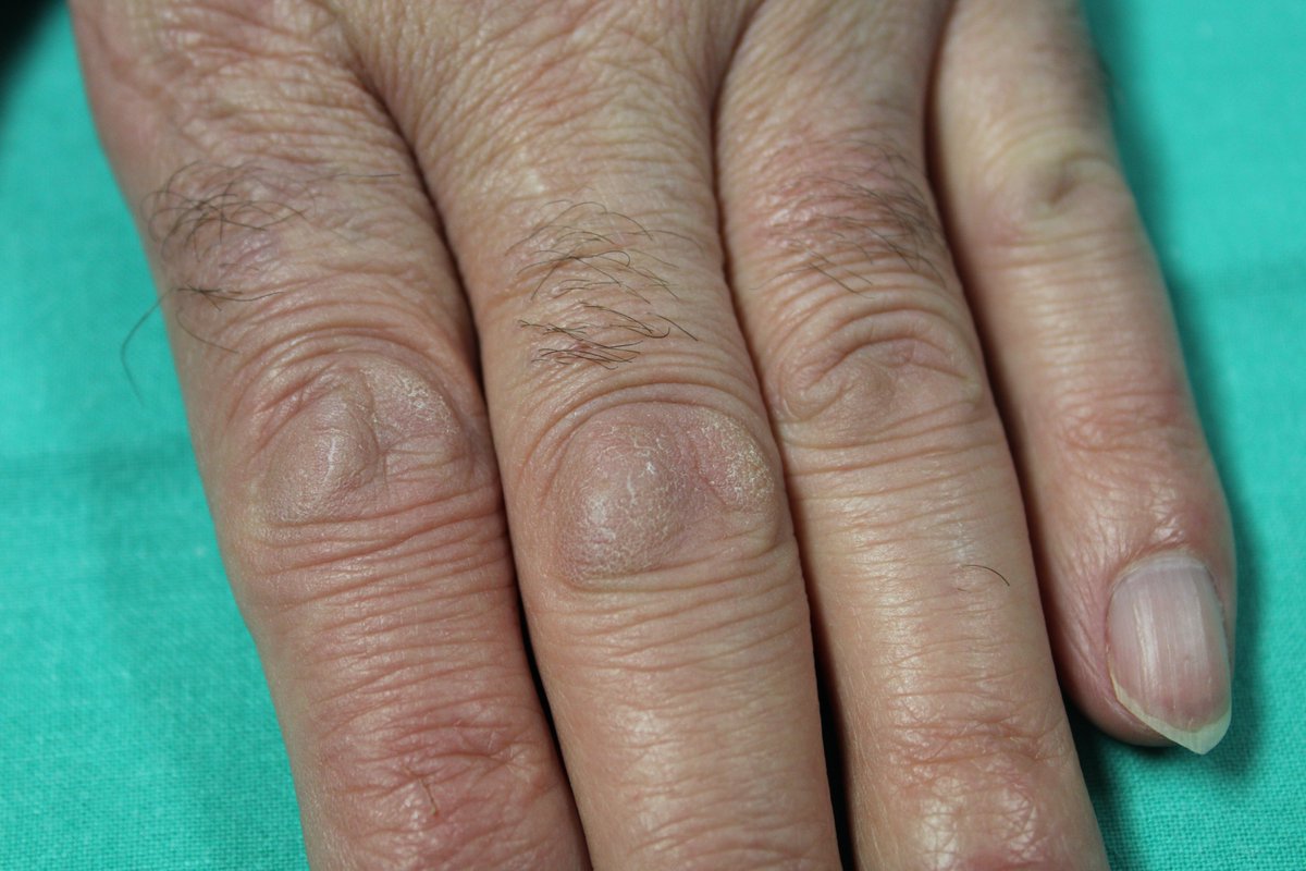 Angel_Moreda's tweet image. Nódulos de Garrod o 'knuckle pads'; una entidad benigna, común y confundida en ocasiones con las pápulas de Gottron.