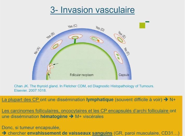 Annpathol's tweet photo. 🔬 Carcinome folliculaire thyroïdien par Dr Belleannée @GBelleanneeMD au #CarrefourPathologie2023 🇲🇫
#pathology #endopath #francophonepath
@SFPathol https://t.co/3UxY79yqnk