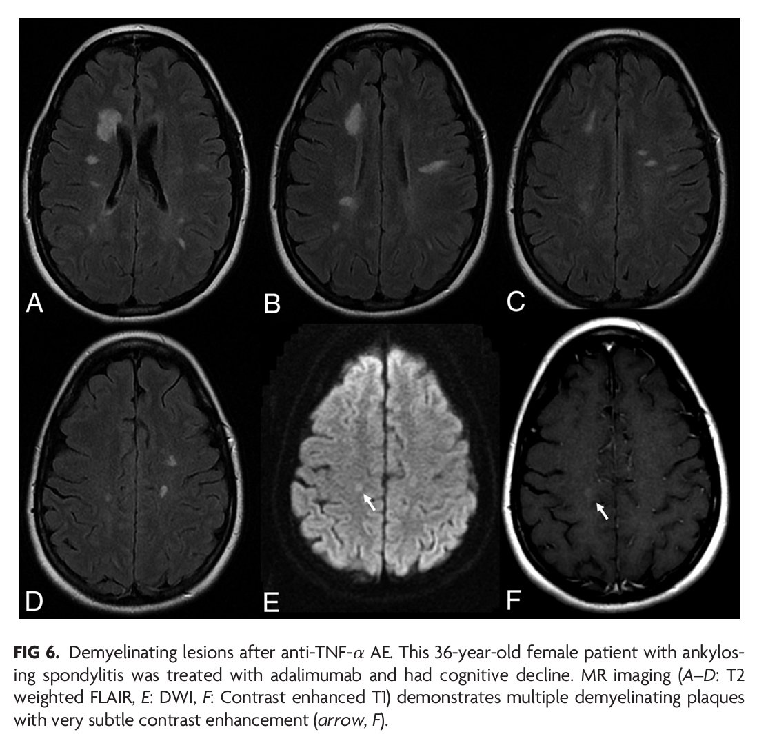 "Monoclonal Antibodies: What the Diagnostic Neuroradiologist Needs to Know" #OpenAccess #ReviewArticle #FellowsJournalClub | bit.ly/3RiHfaN