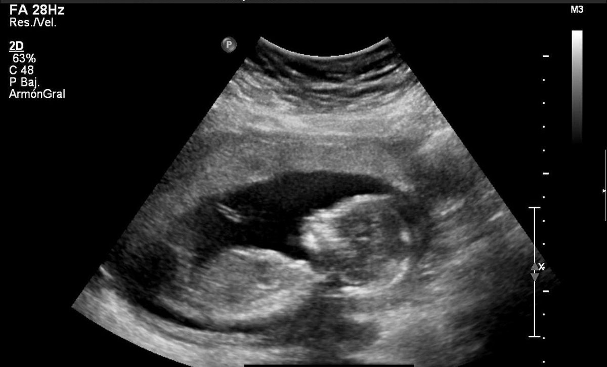 LA VERDAD QUE NO QUIEREN QUE SEPAS 👇🏻
A los 18 días: late su corazón
A los 42 días: Tiene ondas cerebrales
A los 52 días: Le da hipo y bosteza
A las 8 semanas: Funcionan todos sus órganos
A las 10 semanas: Siente dolor
A las 12 semanas: Puede sonreír