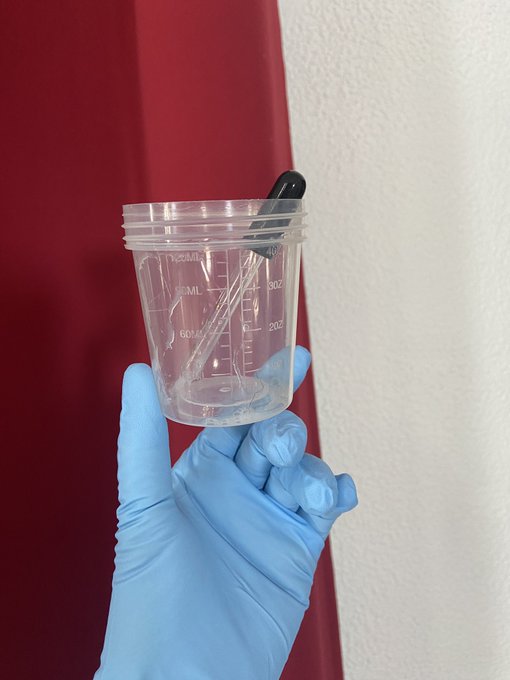 After collecting a sperm sample from the patient, the specimen was tested for quality. Testing was performed