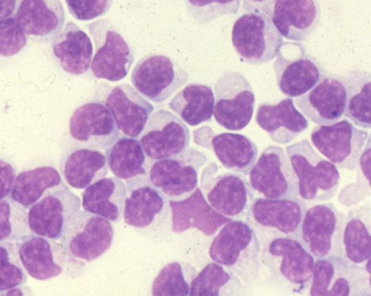Path4People's tweet photo. I am a leukemia associated with patients with these two findings below as well as neutropenia.
I can be CD2, CD3, CD5, CD7 + on flow cytometry and will have a clonal T cell receptor rearrangement
I can have azurophilic granules.
Who am I?🤔
#pathagonia #hemex #medx #pathx https://t.co/91YnTAVeWy