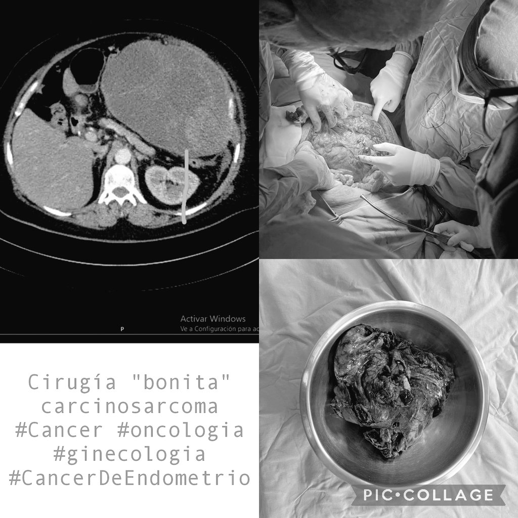 #Carcinosarcoma, #Endometrial, #recurrence, complete #cytoreduction, #surgery, #GynecologicalOncology, #cancer #Gynecology #oncology #DrGMoreno #Gineco drguillermomorenoncologia.com