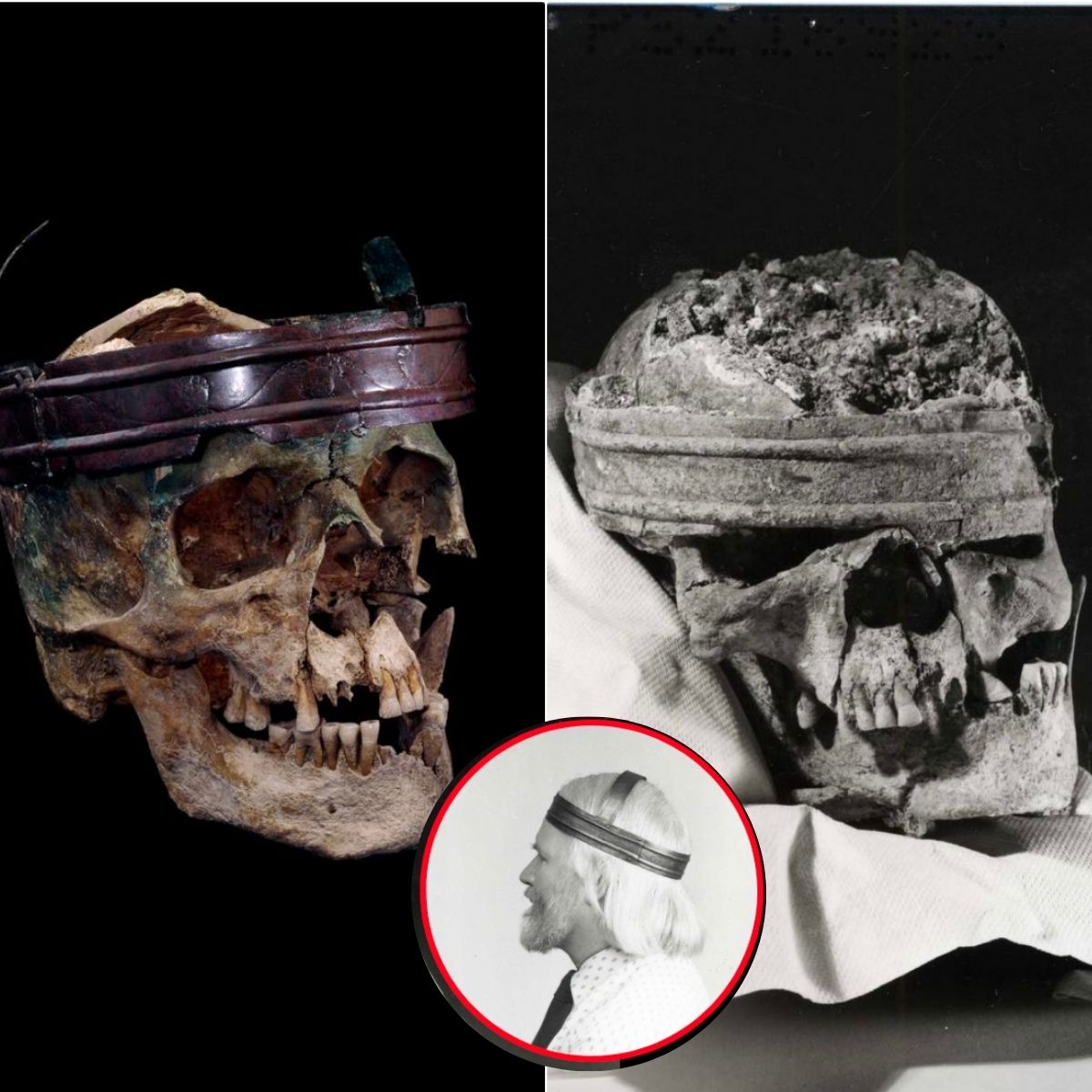Una corona de aleación más adecuada, encontrada y que todavía se encuentra en el cráneo de su dueño, se remonta a la Edad de Iropo, entre 250 y 150 a.C. - NOTICIAS