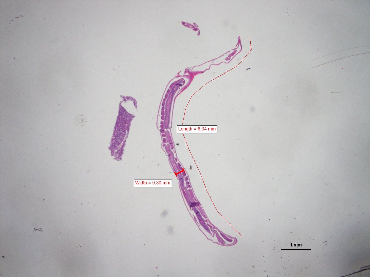 awoke1971's tweet image. #twitterpath #Parasites #pathology Can anyone help identify if this is Enterobius vermicularis? Incidental finding in colonoscopic biopsies.