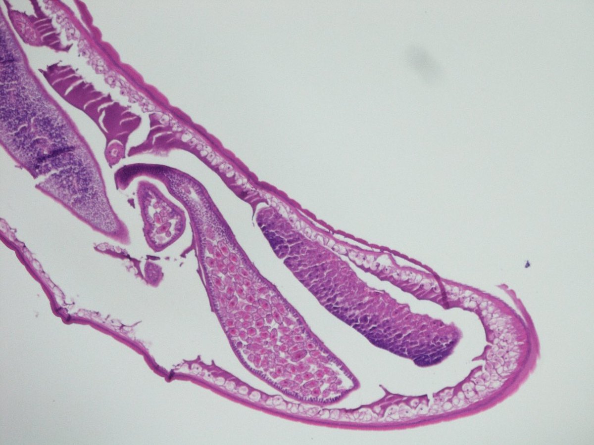 awoke1971's tweet image. #twitterpath #Parasites #pathology Can anyone help identify if this is Enterobius vermicularis? Incidental finding in colonoscopic biopsies.