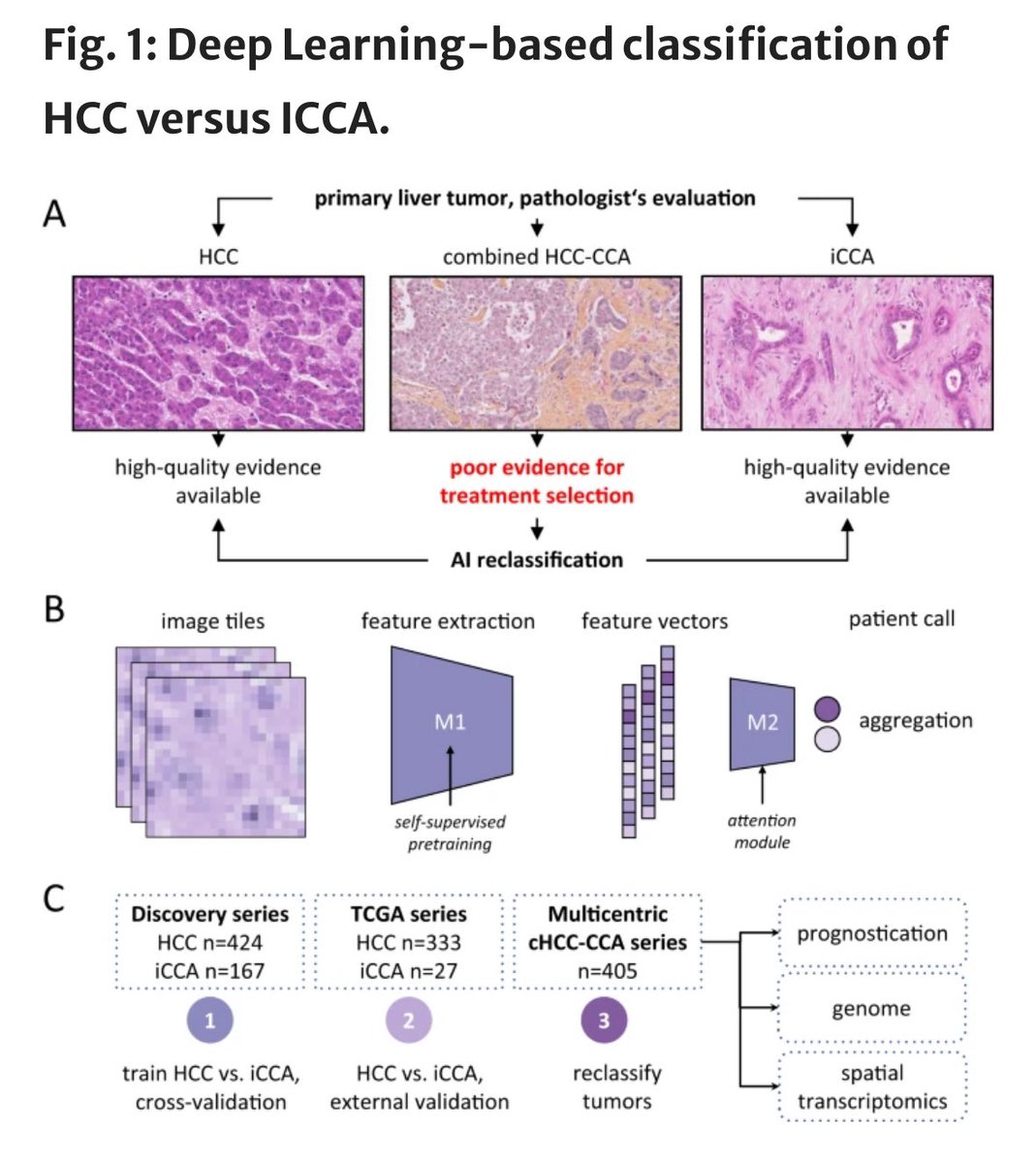 Finally out! Our new paper in @NatureComms, using Deep Learning to re-classify combined HCC-CCA liver tumors. Massive collaboration, mostly in 🇫🇷, led by @Caldera60373705, @QingheZeng and @GhaffariNarmin 🏥 @tudresden_de @APHP, @EASLnews @ILCAnews 🇪🇺🤩 👉doi.org/10.1038/s41467…