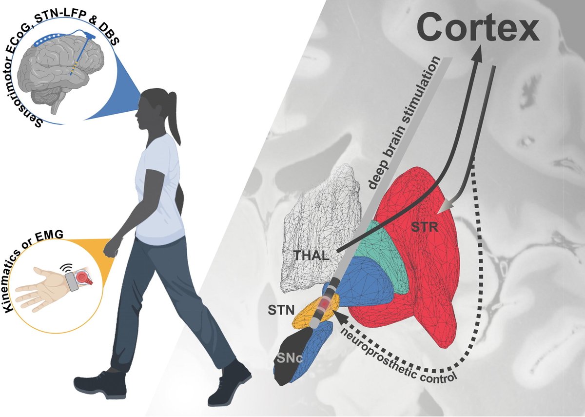 ClinicalNeuroph's tweet image. [Parkinson’s disease (PD)] Neumann: "Combining cortical brain signal recordings with subcortical stimulation informed by machine learning algorithms may provide the necessary foundation for a neuroprosthetics approach to deep brain stimulation in PD."

doi.org/10.1016/j.clin…