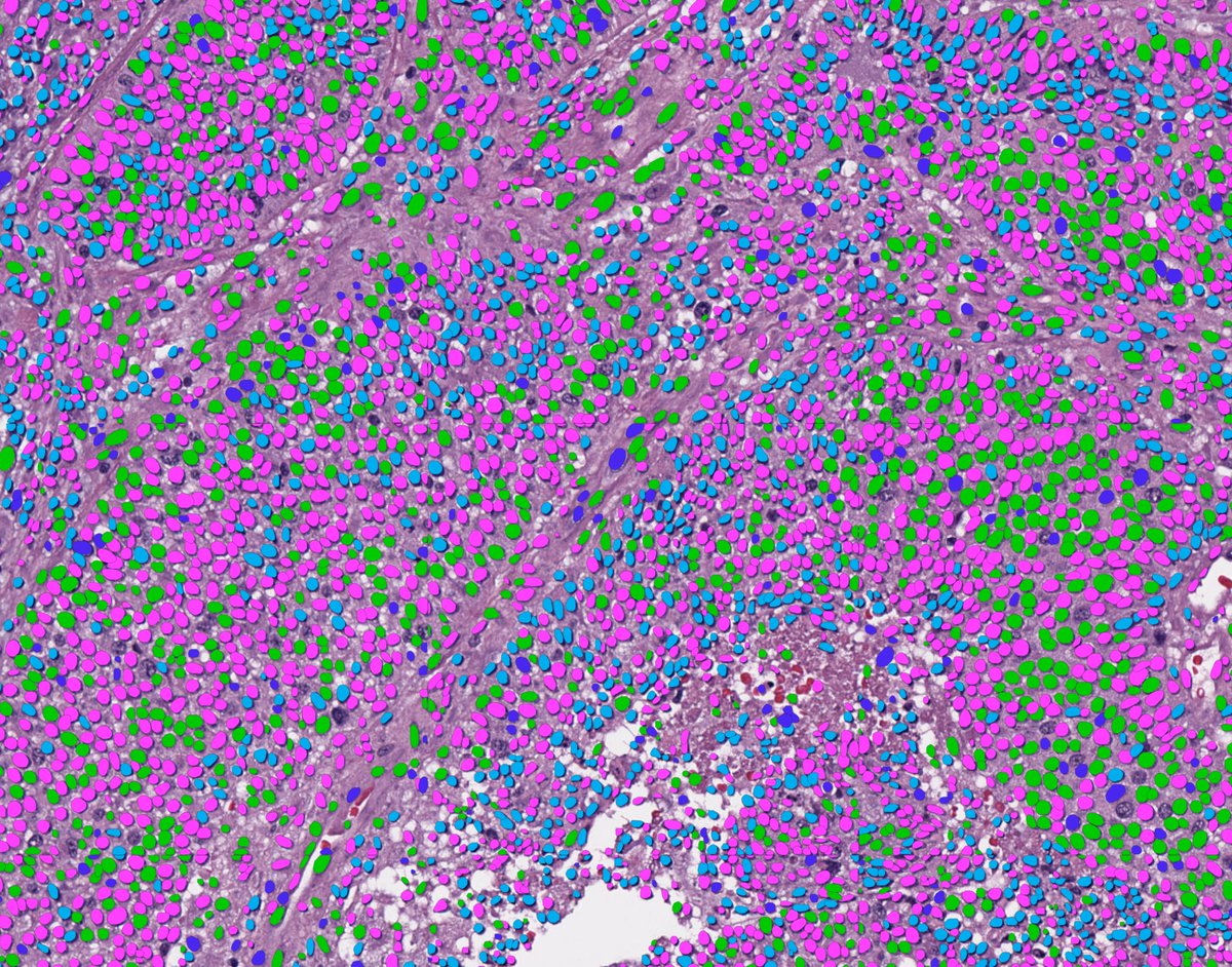 Almost 1,000,000 cells were annotated and billions of cells were detected in 2023 with the DeePathology STUDIO!
Stop counting cells manualy and embrace the power of AI.

Join our webinar on December 20th at 5:00 PM CET.
us06web.zoom.us/webinar/regist…