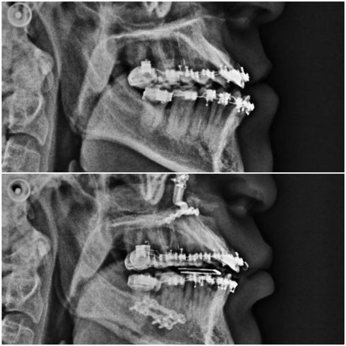 Patient-specific surgical guide for maxillofacial surgery (CMD IIa) in case of advancement mentoplasty that requires bimaxillary forward and counterclockwise rotation surgery <a href="/3d_maranon/">FabLab 3D Hospital Marañón</a> <a href="/rupermac/">Rubén Pérez-Mañanes, MD PhD</a> <a href="/calvoharo_ja/">José Antonio Calvo</a> #UPAM3D #HospitalGregorioMarañon #impresion3D