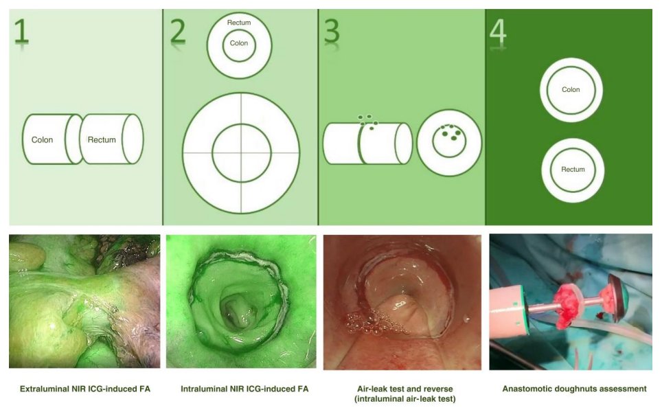 #ICYMI ‘4-Check’ protocol for intraoperative anastomotic assessment during transanal total mesorectal excision: retrospective cohort study
➡️doi.org/10.1093/bjsope…
The '4-Check' multimodal anastomotic integrityprotocol, incl. 
🟢indocyanine green-evaluation of colonic stump and