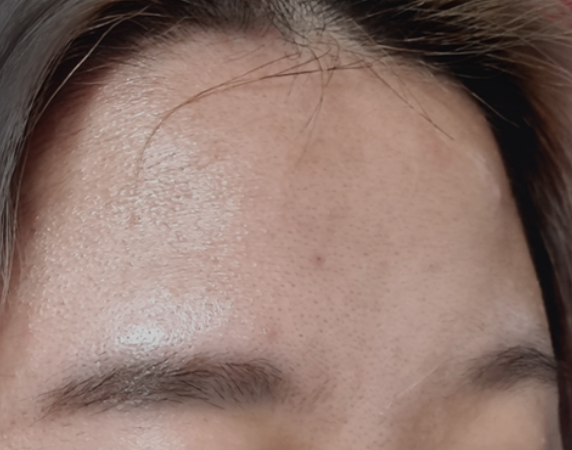 pjyiskra's tweet photo. 의사유튜버가 말한 30초 균세안법 5일했는데
이마 깨끗해진거보세요...말이됨?
다 필요없고 전문의나 종사자 말 믿는게 베스트임
유튜브 닥터미수다 30초 균세안법편
타래로 https://t.co/v9JCJtFXka