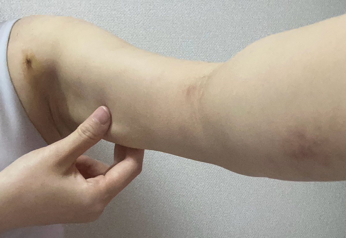 py55257's tweet photo. 二の腕脂肪吸引DT12日目

普段は柔らかい二の腕の内側が拘縮。
これ以上つまめない🤌
かゆいし白く粉吹いてきたので、ボディクリーム塗って保湿したらだいぶ収まりました。

写真は撮ってないけど脇腹も拘縮&amp;かゆい！

#二の腕脂肪吸引 #背中脂肪吸引 #ラブハンドル脂肪吸引
#狎鴎亭トップライン https://t.co/3Ip6plHxtc
