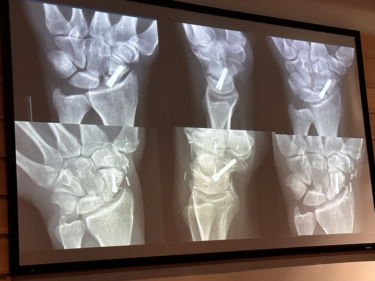 Richard Redett (@rredett) on Twitter photo Great talk <a href="/HopkinsPlastic/">Johns Hopkins Plastic & Reconstructive Surgery</a> grand rounds by innovative hand surgeon Dr. Jim Higgins from Curtis National Hand Center discussing his experience with vascularized cartilage transfers for scaphoid nonunions. <a href="/CNHC_research/">Curtis National Hand Center Research</a> #handsurgery Great talk <a href="/HopkinsPlastic/">Johns Hopkins Plastic & Reconstructive Surgery</a> grand rounds by innovative hand surgeon Dr. Jim Higgins from Curtis National Hand Center discussing his experience with vascularized cartilage transfers for scaphoid nonunions. <a href="/CNHC_research/">Curtis National Hand Center Research</a> #handsurgery