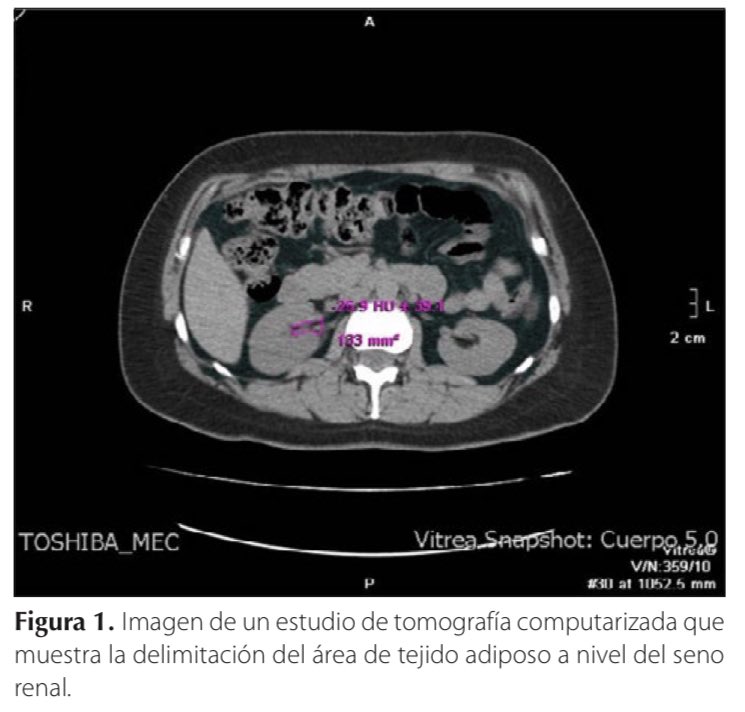 El tejido adiposo perirrenal aumenta en el síndrome metabólico y se relaciona con deterioro renal Descárgalo en la @RevistaEndoMex de la @SMNE_Oficial . revistadeendocrinologia.com/files/rme_23_1…