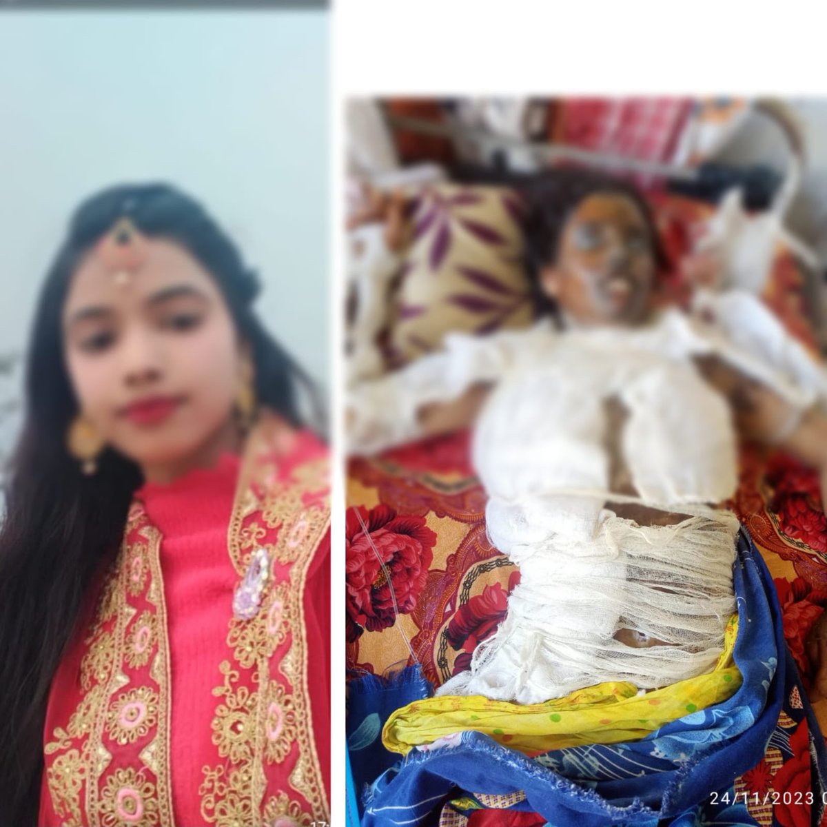 Loss the Battle of Life : Nirufa Akhtar, a Victim Acid Attack. In the peaceful haven of Kayakuchi, Assam, the world of 15-year-old Nirufa Akhtar crumbled on November 19, 2023, when a heartless acid attack left her body scarred and stole the light from her eyes. Tragically,