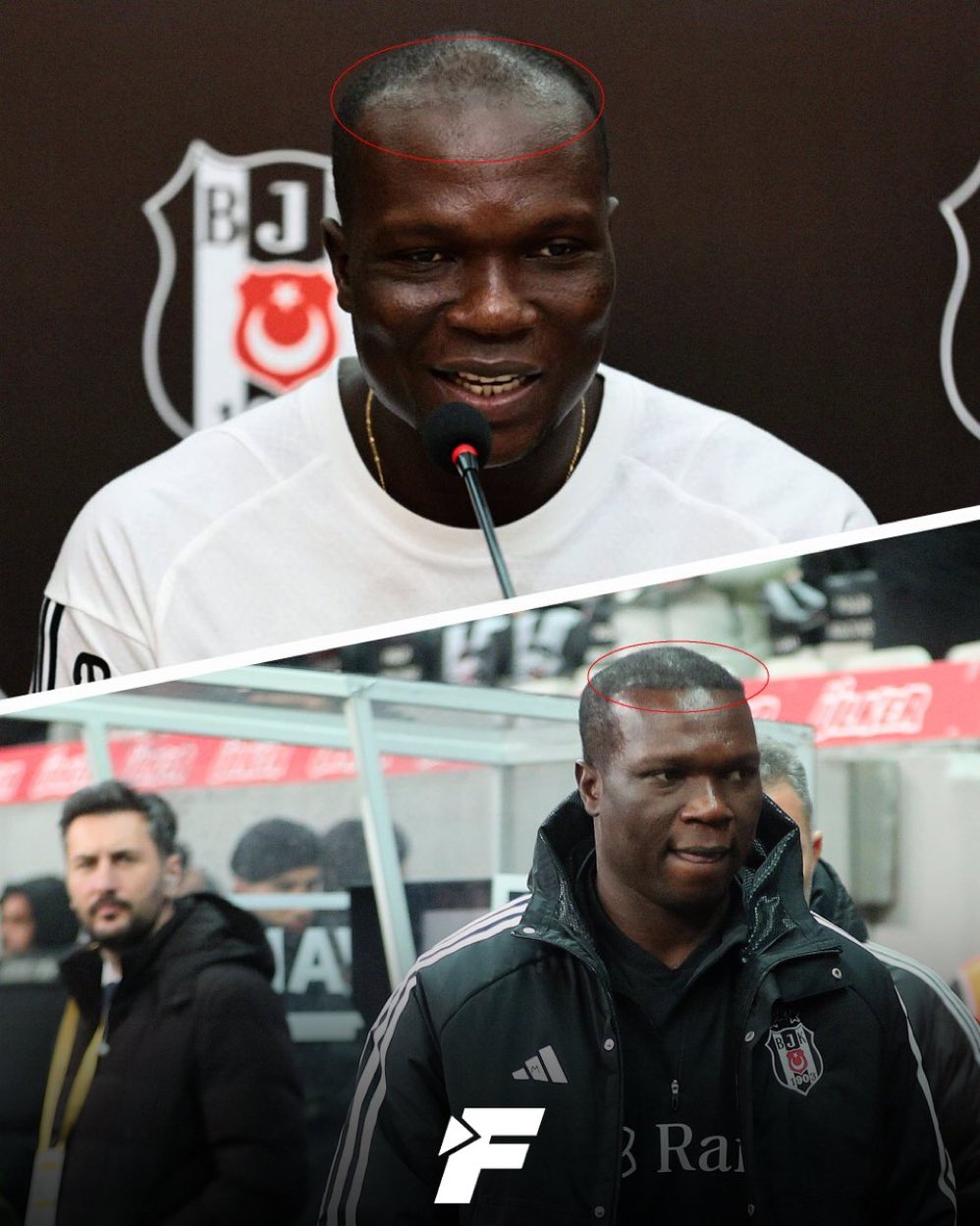 Aboubakar e Besiktas em ponto rutura devido a um transplante capilar