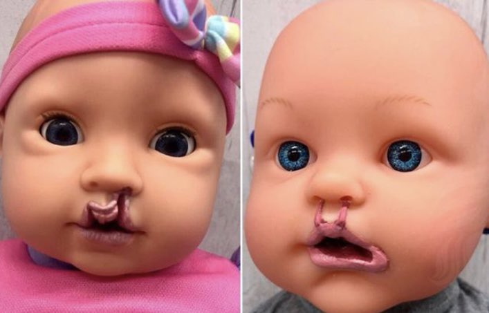 Mãe cria bonecas para crianças com fissuras lábio-palatinas