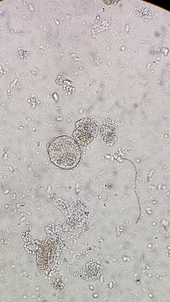 I love Balantioides coli. 🦠 Such a fun organism...but, be careful with iodine and 40X objectives though...easy to overlook. 10X objective screening is critical for this organism. See the difference? Look at those cute little cilia! #parasitology
<a href="/ARUPLabs/">ARUP Laboratories</a> <a href="/ParasiteGal/">Bobbi Pritt, MD</a>