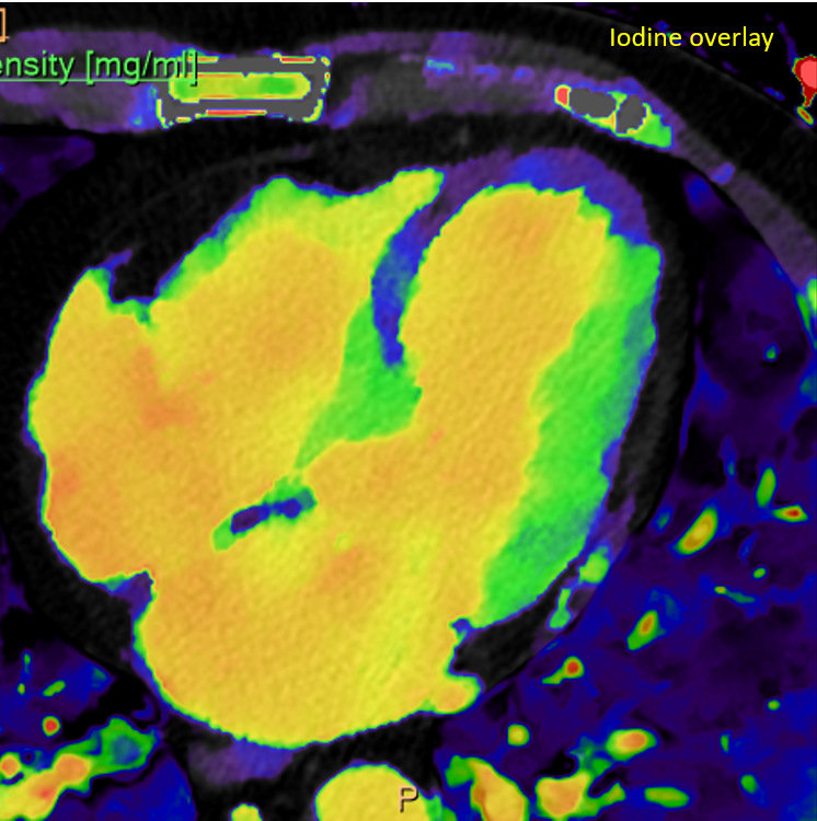 Acute MI on #SpectralCT. Much easier to see on low-keV image and iodine overlay.
#FOAMed #radres