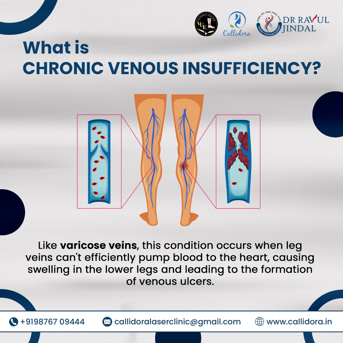 Treatment for this condition typically involves lifestyle changes, compression therapy, and, in severe cases, medical procedures. 

Book an appointment at 9876709444 for consultation.

#drravuljindal
#venousdisease
#venousulcer #venousulcereradication