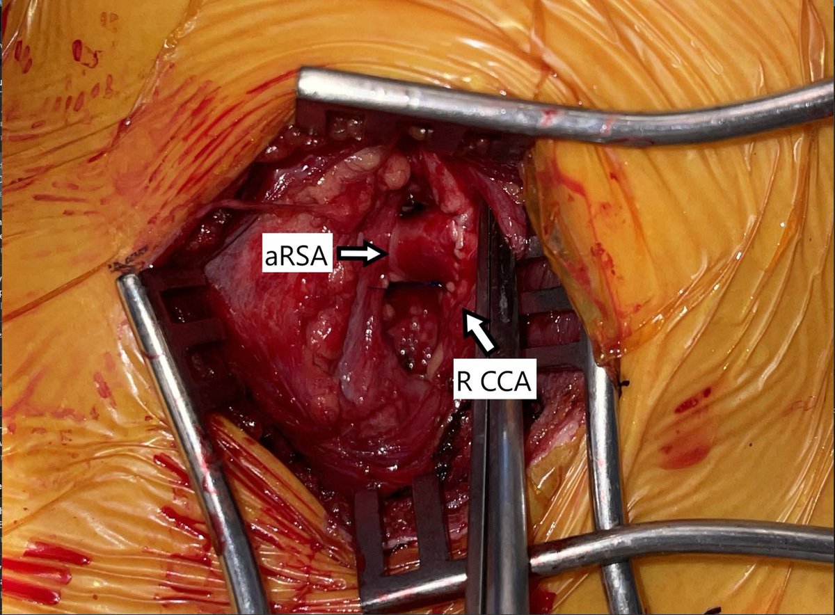 Dysphagia lusoria due to aberrant RSA and Kommerell diverticulum. Robotic-assisted RSA ligation off the aortic arch followed by RSA transposition to R CCA. The robotic mediastinal mobilization led to a quick transposition. Dysphagia resolved. Home on POD 3. #aortaed